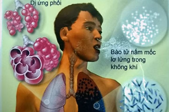 Bệnh nấm phổi, đừng chủ quan