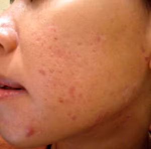 Bài thuốc Đông y chữa mụn trứng cá hiệu quả