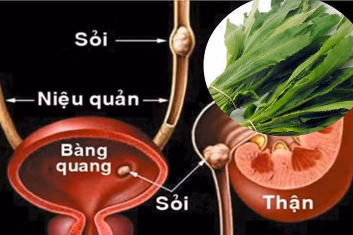 Dùng mùi tàu theo cách này, sỏi trong thận có thể sẽ đào thải hết ra ngoài sau 7 ngày