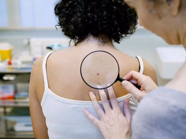 Những dấu hiệu về ung thư da mà bạn không nhìn thấy