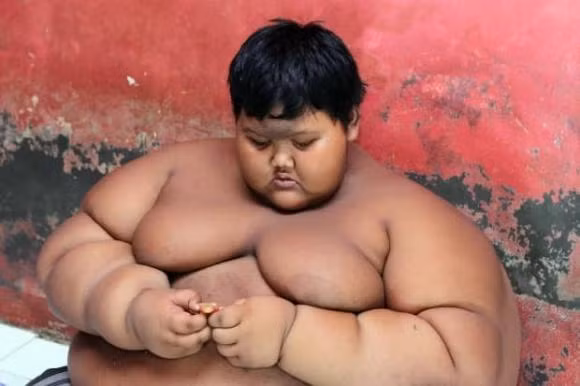 Cậu bé béo nhất thế giới, Arya Permana