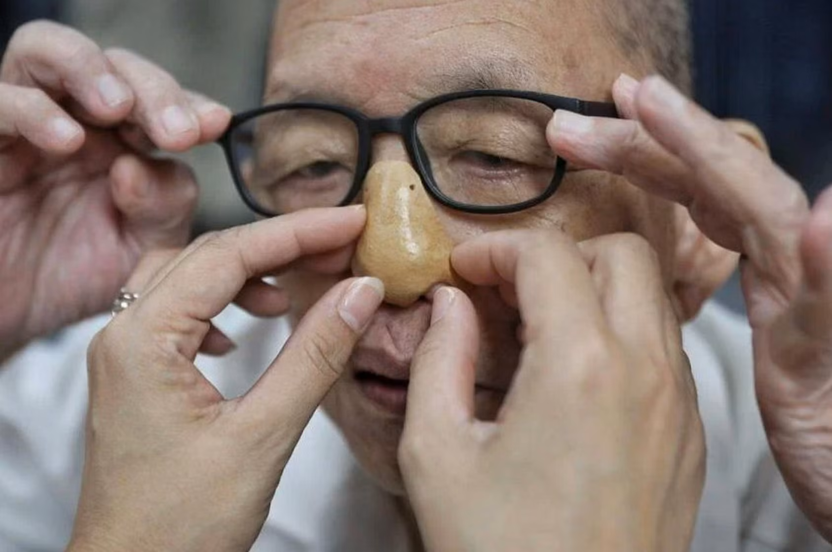Mũi in 3D dành cho các bệnh nhân ung thư ở Singapore. Ảnh: The Straits Times