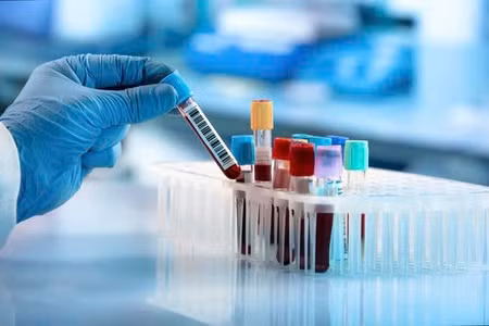 Xét nghiệm máu giúp chẩn đoán 'Hội chứng mệt mỏi mạn tính' chính xác