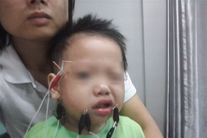 Không ít trẻ bị liệt cơ mặt do bị lạnh. (Ảnh minh họa)