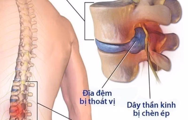 đau rễ thần kinh cột sống