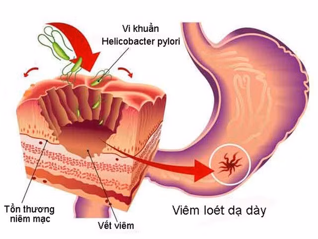 Tìm hiểu các phương pháp điều trị viêm dạ dày HP hiệu quả ảnh 1 Viêm dạ dày HP