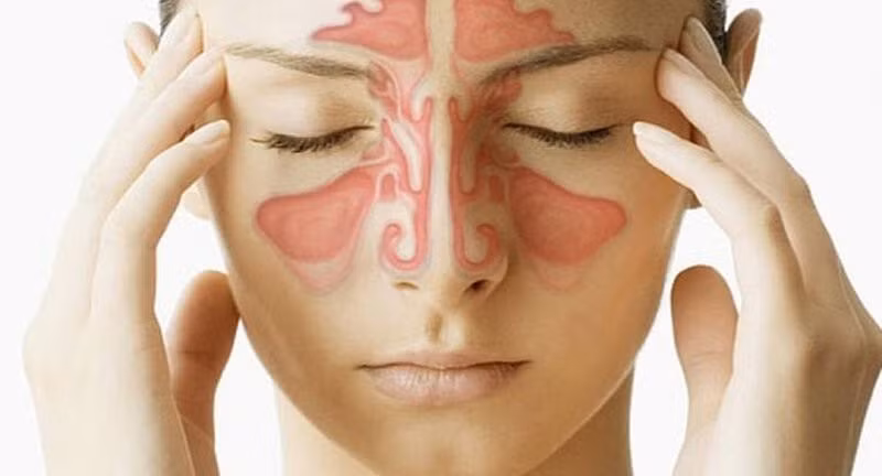 Cách phân biệt nhức đầu do viêm xoang và đau nửa đầu ảnh 2 nhức đầu do viêm xoang
