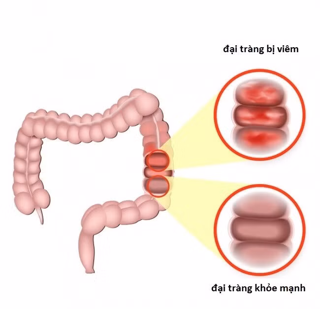 Sôi bụng tiêu chảy