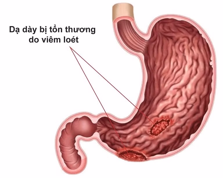 đau dạ dày đầy hơi