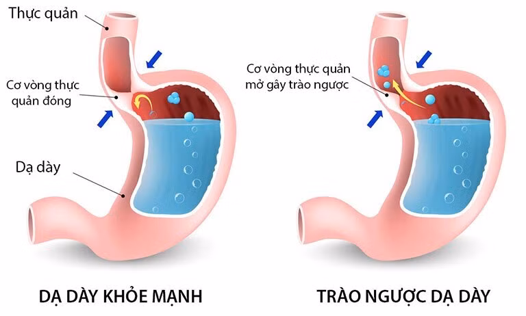 Đau dạ dày sau khi ăn 