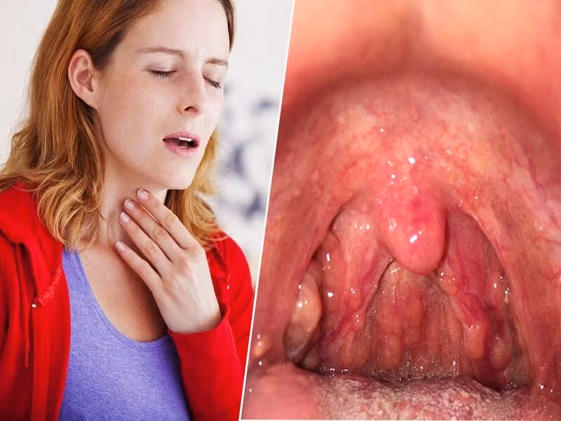 viêm họng ở phụ nữ mang thai