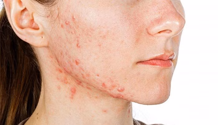 thuốc mát gan trị mụn