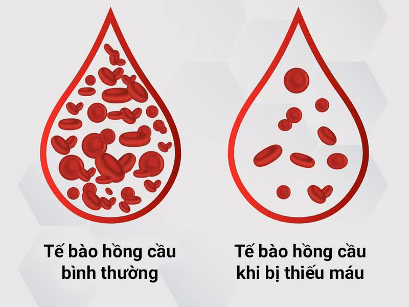 Thiếu máu bổ sung gì