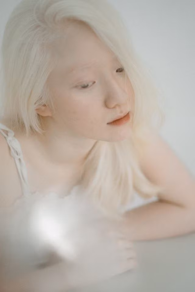 Nữ sinh bạch tạng đẹp như nàng thơ ảnh 3