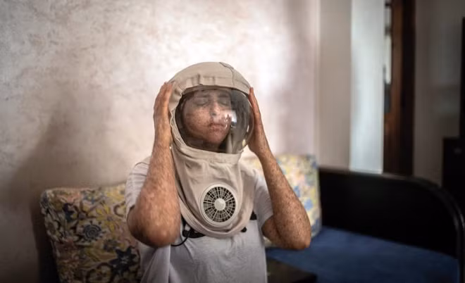 Fatima luôn phải đội chiếc mũ đặc biệt để bảo vệ da mỗi khi ra ngoài.