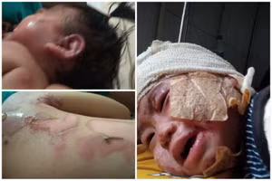 Bị ngã vào nồi canh đang sôi khiến bé Như Quỳnh bỏng nặng.