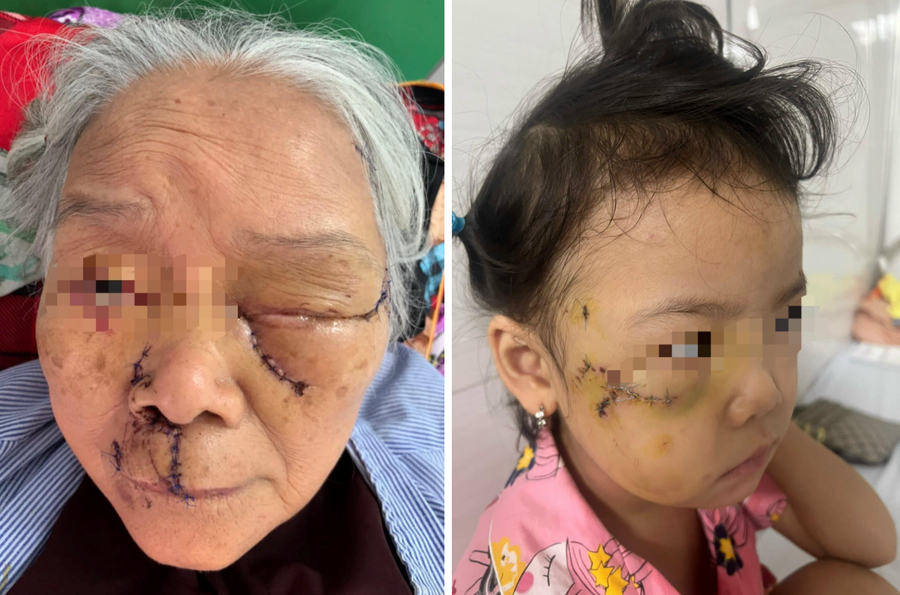 Trường hợp người cao tuổi và trẻ em bị chó tấn công vào vùng mặt