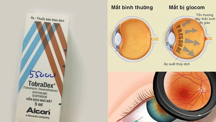 Lạm dụng thuốc nhỏ mắt chứa corticoid gây ra bệnh Glaucoma. Lạm dụng thuốc nhỏ mắt chứa corticoid gây ra bệnh Glaucoma.