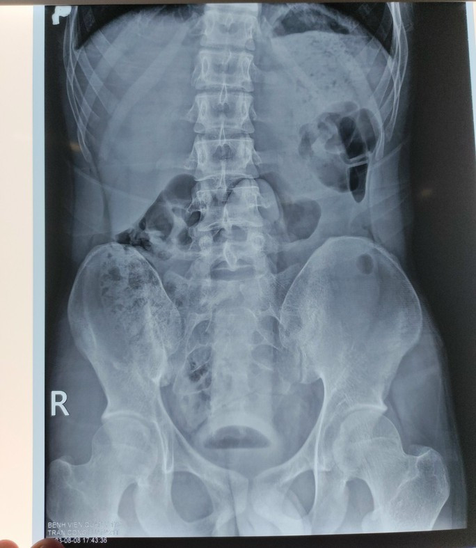 Hình ảnh dị vật qua phim chụp Xquang