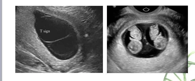 Thai nhi cùng trứng khác kiểu hình và kiểu gene. Ảnh: Bệnh viện Phụ sản Hà Nội