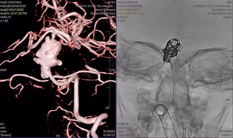 Túi phình mạch máu não khổng lồ ở vị trí hiểm hóc được bít lại, tránh cho bé gái nguy cơ bị vỡ túi phình, đột quỵ xuất huyết não. Nguồn: BV .