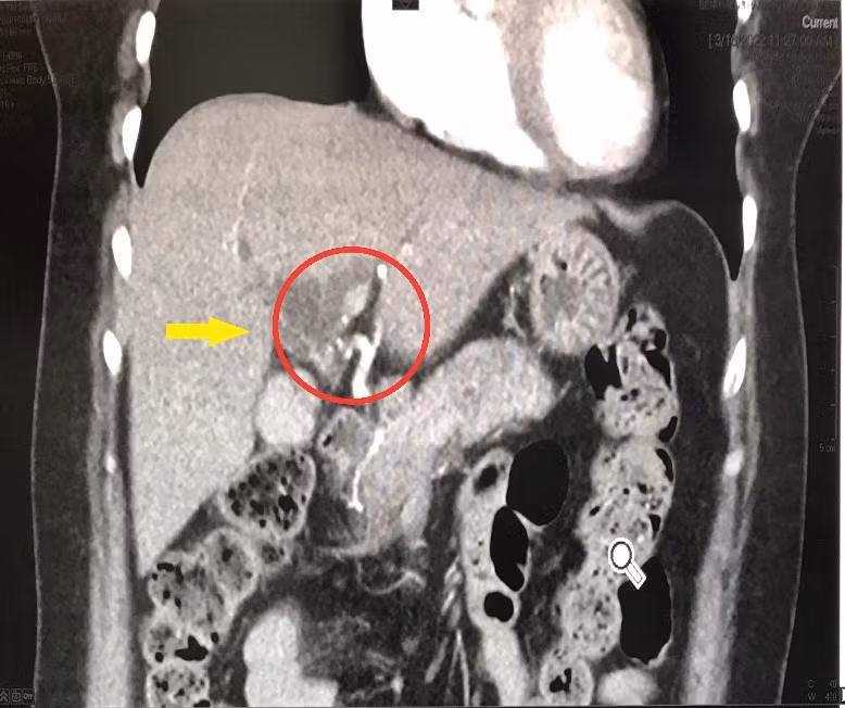 Hình chụp CT cắt lớp vi tính 3D phát hiện khối U đường mật rốn gan ác tính. Ảnh: BV.