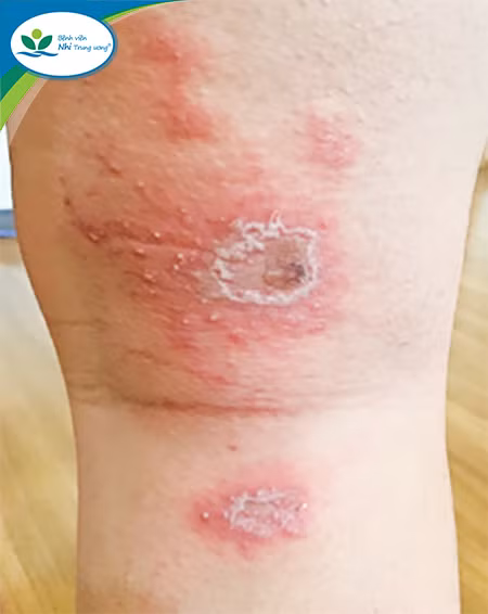 Tổn thương dạng hôn. Nguồn: BV Nhi Trung ương.