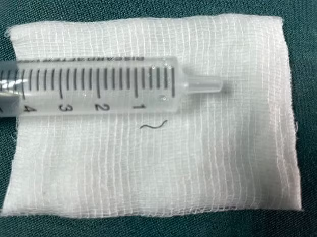 Mảnh tôn được lấy ra từ mắt bệnh nhân. Ảnh: SKĐS.