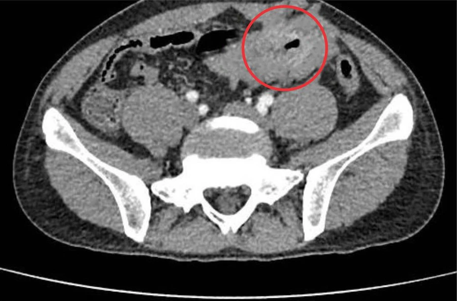 Hình chụp CT Scan phát hiện khối u GIST ruột non bị thủng. 