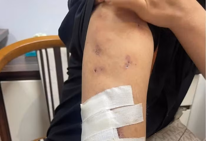 Những vị trí trên cơ thể bệnh nhân sau khi chích kim bơm chất tan mỡ đều nhiễm trùng hoại tử. Ảnh: TPO.