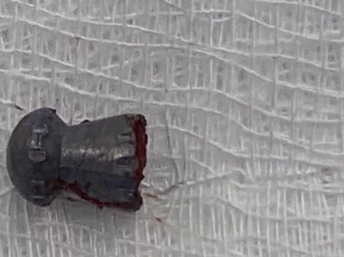 Ê kíp bác sĩ nhiều khoa phải phẫu thuật gần 3 giờ mới lấy ra được đầu đạn ra. Ảnh: BV.