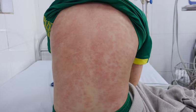 Hình ảnh ban mọc toàn thân của bệnh nhân.