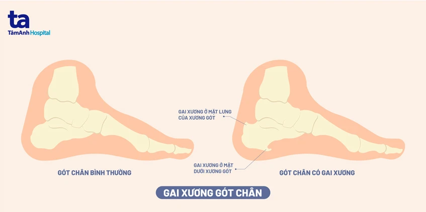 Chuyên gia y tế liệt kê 5 cách hiệu quả ngăn ngừa gai xương