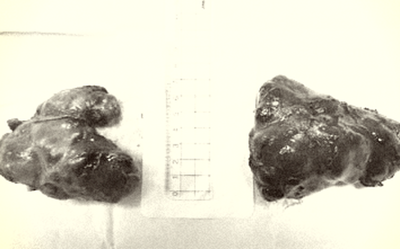 Cắt bỏ khối bướu giáp gần 20 năm cho người phụ nữ 60 tuổi ảnh 1 Cắt bỏ khối bướu giáp gần 20 năm cho người phụ nữ 60 tuổi ảnh 1