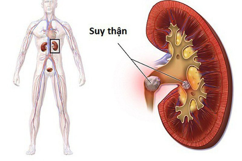 Suy thận là căn bệnh vô cùng nguy hiểm. Ảnh minh hoạ. Suy thận là căn bệnh vô cùng nguy hiểm. Ảnh minh hoạ.