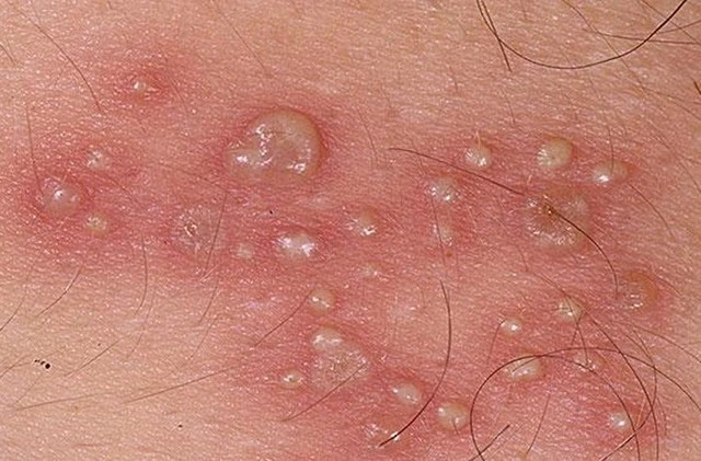 4 loại bệnh để lâu sẽ dẫn đến ung thư