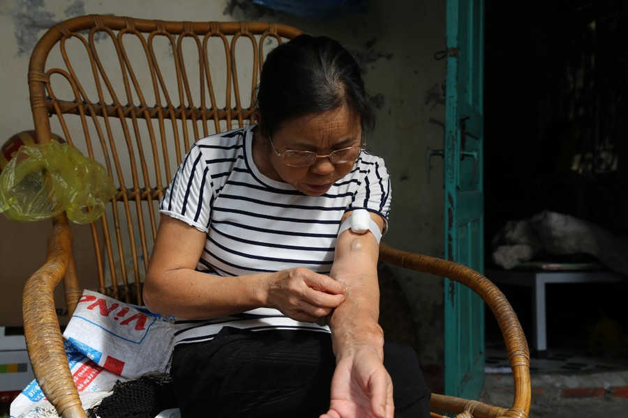 Cánh tay trái của cô Hoàng Thị Năm xuất hiện nhiều cục tròn do việc cắm kim tiêm để lọc máu điều trị suy thận. Ảnh: B.M. Cánh tay trái của cô Hoàng Thị Năm xuất hiện nhiều cục tròn do việc cắm kim tiêm để lọc máu điều trị suy thận. Ảnh: B.M.