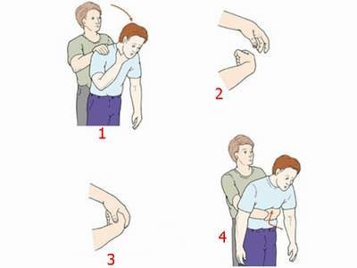 Xử lý sự cố hóc dị vật đúng cách sẽ mang lại cơ hội sống cho nhiều người. Ảnh: Dieutri.vn. Cách xử lý những sự cố dễ gặp ngày Tết