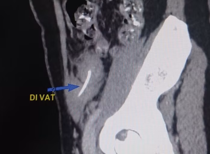 Bệnh nhân đau âm ỉ hạ vị khoảng 10 ngày. Ảnh: BVCC
