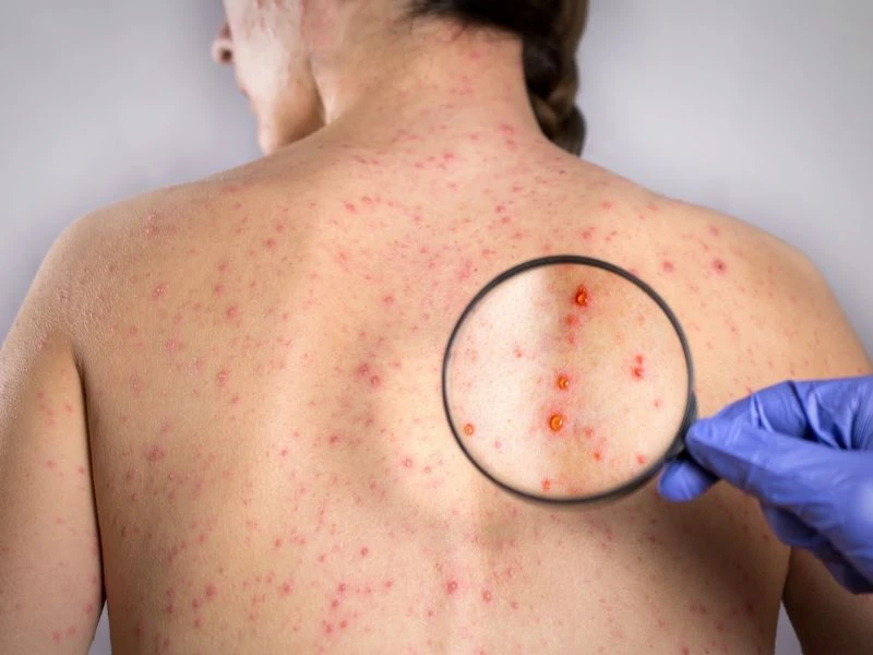 Phát hiện sớm virus rubella sẽ giảm thiểu được nguy cơ dị tật bẩm sinh với thai nhi.