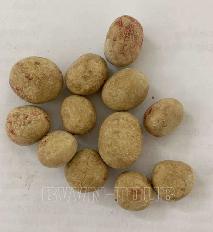 12 viên sỏi được lấy ra từ bàng quang của người bệnh. Ảnh: BV. 12 viên sỏi được lấy ra từ bàng quang của người bệnh. Ảnh: BV.