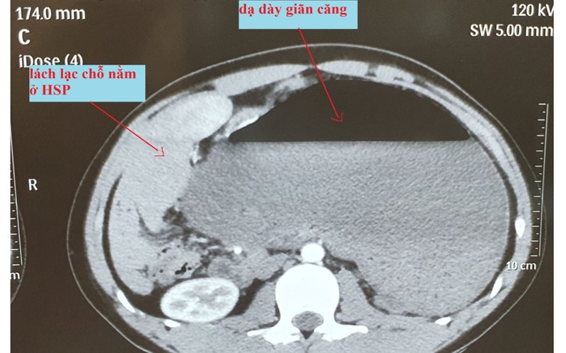 Hình ảnh chụp cắt lớp vi tính của bệnh nhân. Ảnh: BV.