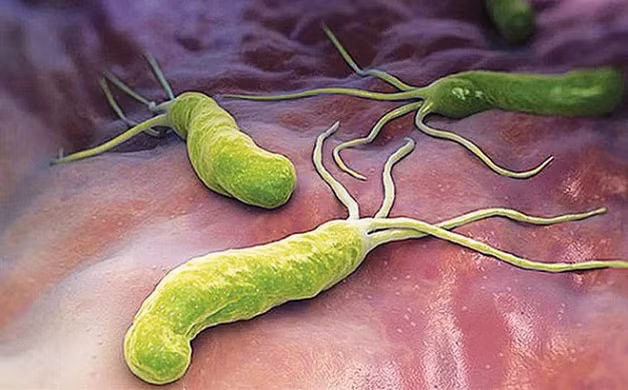 Vi khuẩn HP là nguyên nhân hàng đầu gây bệnh.