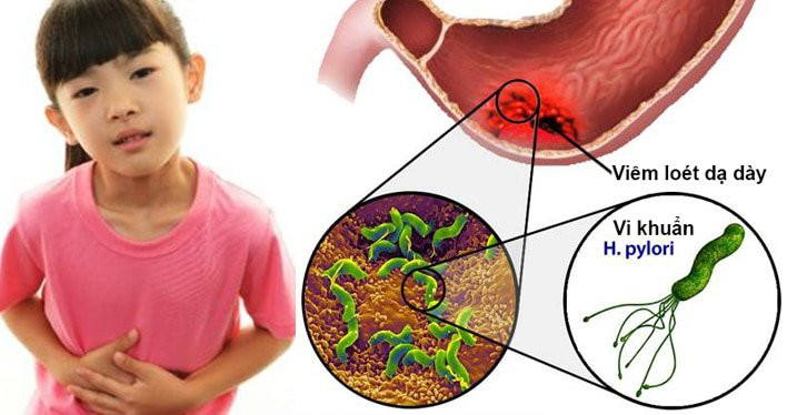 Để xác định chính xác có nhiễm vi khuẩn HP dạ dày hay không, bạn cần thực hiện xét nghiệm kiểm tra. Ảnh minh họa. Để xác định chính xác có nhiễm vi khuẩn HP dạ dày hay không, bạn cần thực hiện xét nghiệm kiểm tra. Ảnh minh họa.