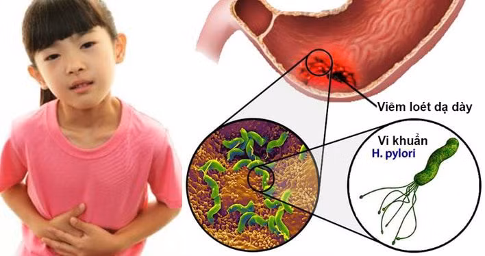 Để xác định chính xác có nhiễm vi khuẩn HP dạ dày hay không, bạn cần thực hiện xét nghiệm kiểm tra. Ảnh minh họa.