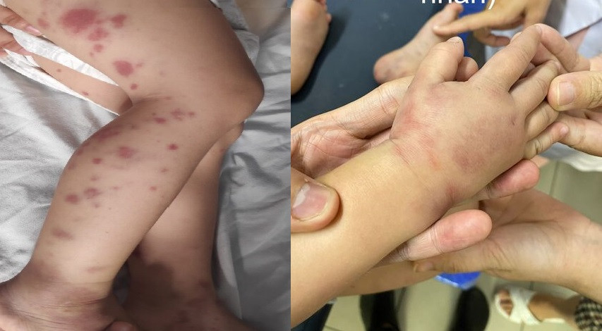 Đa số biểu hiện ban xuất huyết da dễ nhầm lẫn với viêm mô tế bào hoặc ban xuất huyết giảm tiểu cầu hay bệnh lý khác nên phụ huynh cẩn thận không tự ý mua thuốc cho con em mình uống. Ảnh: BV. Đa số biểu hiện ban xuất huyết da dễ nhầm lẫn với viêm mô tế bào hoặc ban xuất huyết giảm tiểu cầu hay bệnh lý khác nên phụ huynh cẩn thận không tự ý mua thuốc cho con em mình uống. Ảnh: BV.