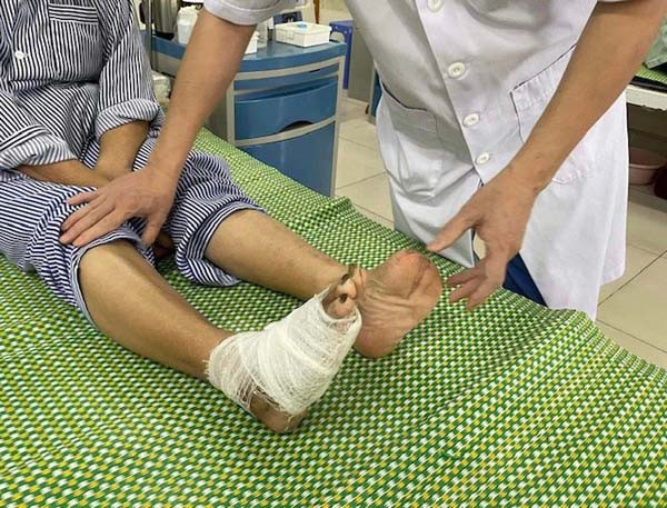 Có trường hợp nữ bệnh nhân 67 tuổi Hà Nội vừa trải qua cuộc phẫu thuật cắt 2 đoạn xương bàn chân phải do biến chứng đái tháo đường. Ảnh: BV. Có trường hợp nữ bệnh nhân 67 tuổi Hà Nội vừa trải qua cuộc phẫu thuật cắt 2 đoạn xương bàn chân phải do biến chứng đái tháo đường. Ảnh: BV.