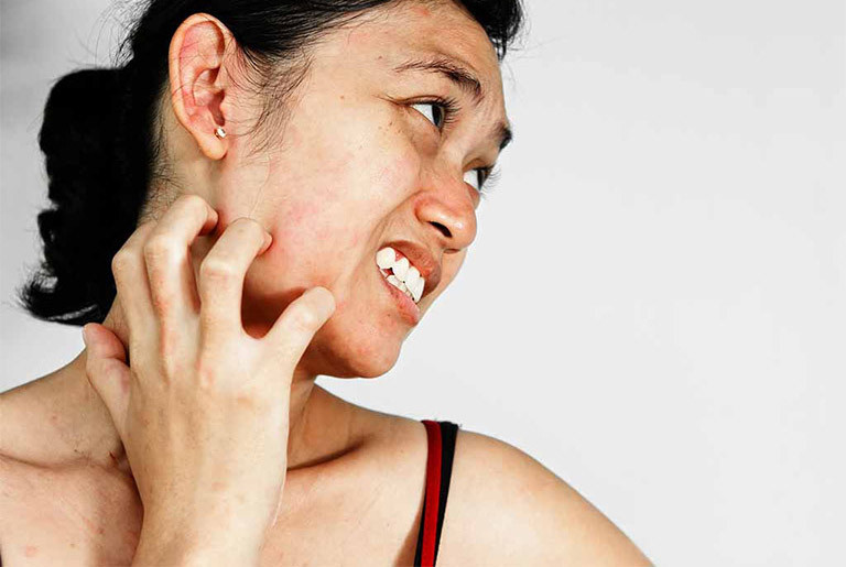 Trong một số trường hợp, cần thiết ngưng sử dụng và thay thế các loại thuốc gây ngứa bằng thuốc khác không gây ngứa. Ảnh minh họa.