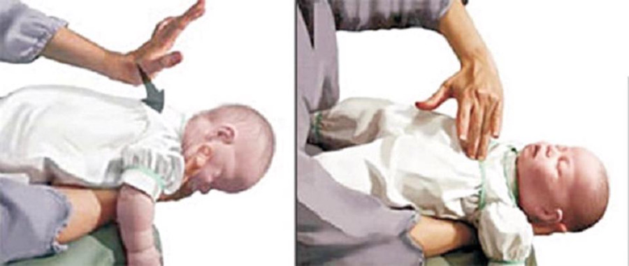 Sơ cứu trẻ dưới 2 tuổi mắc dị vật đường thở bằng cách vỗ lưng và ấn ngực. Sơ cứu trẻ dưới 2 tuổi mắc dị vật đường thở bằng cách vỗ lưng và ấn ngực.