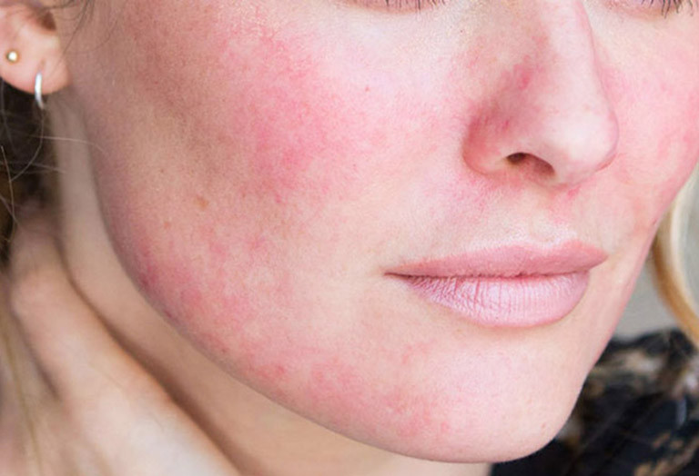 Ngứa mạn tính có thể ảnh hưởng đến tâm trạng và giấc ngủ từ đó làm giảm chất lượng cuộc sống của họ. Ảnh minh họa.